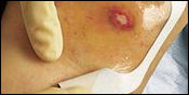 Transparent Dressing, Transparent Dressings